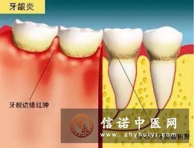 牙龈出血了是怎么回事