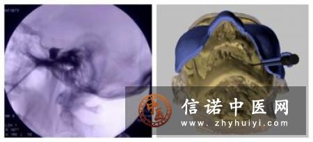 三叉神经痛的球囊压迫治疗原理和并发症