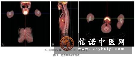 病理发射之下颌反射检查法
