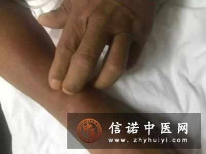 三叉神经节小神经丛的兴奋理论
